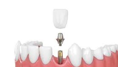 Dental Implants