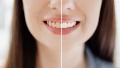 teeth whitening treatment aberdeen