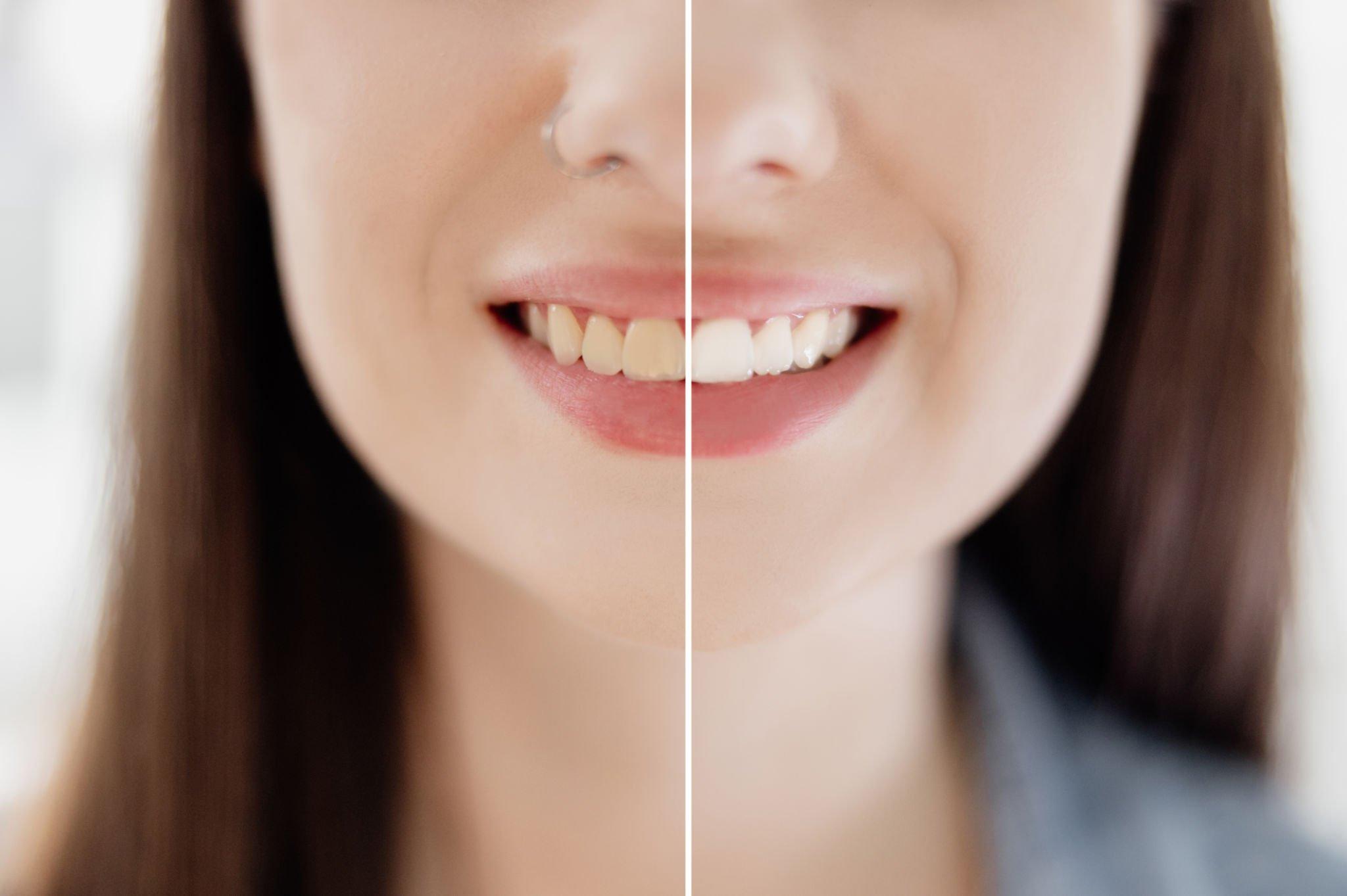 teeth whitening treatment aberdeen