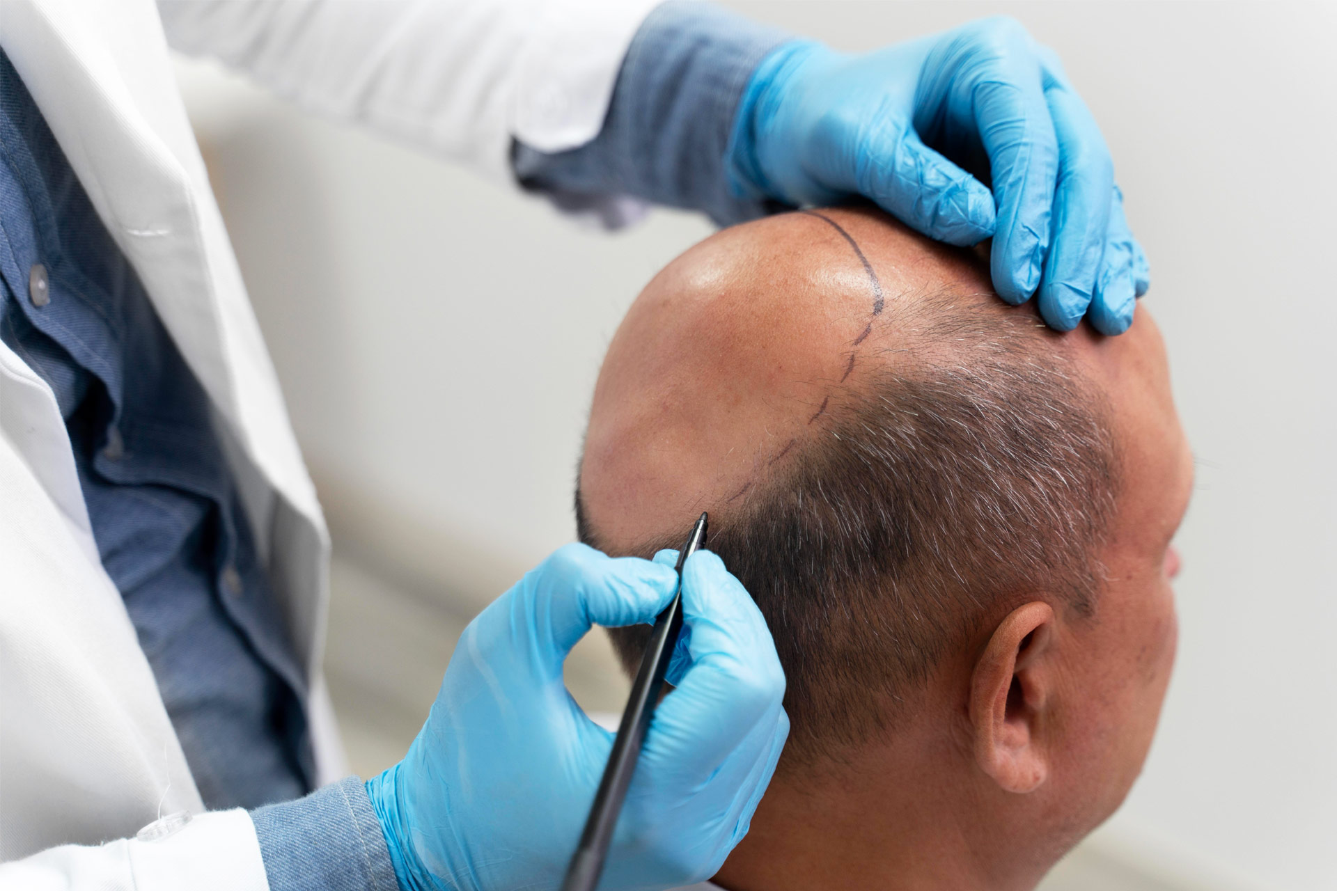 hair transplant turkey cost