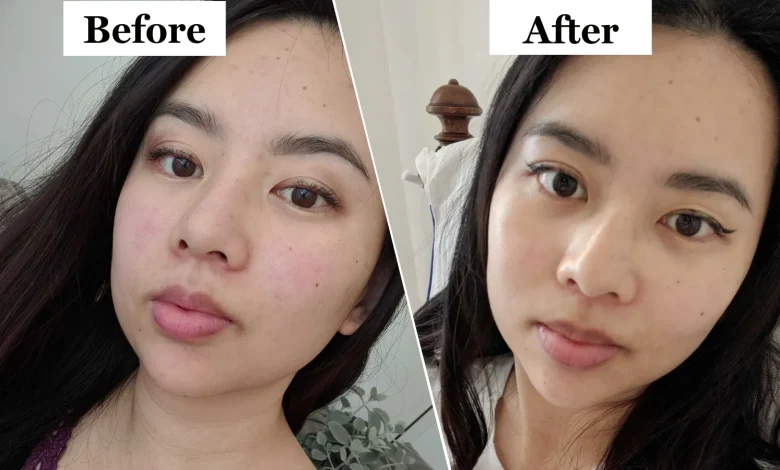 How Much Does Masseter Botox Cost and Is It Worth It