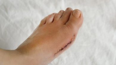 What Happens During Bunion Surgery