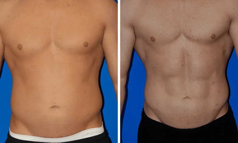 Liposuction