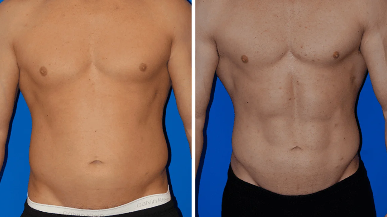 Liposuction