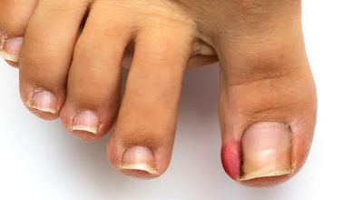 How Does Partial Toenail Removal Help Treat Infections