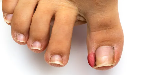 How Does Partial Toenail Removal Help Treat Infections